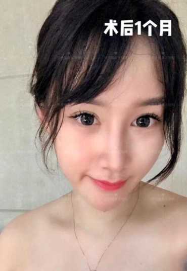 科学变美｜怎么提高正脸颜值，鼻骨内推必须了解