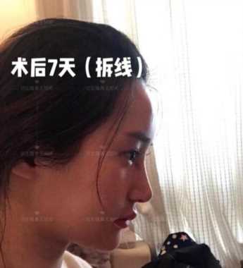 科学变美｜怎么提高正脸颜值，鼻骨内推必须了解