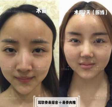 科学变美｜怎么提高正脸颜值，鼻骨内推必须了解