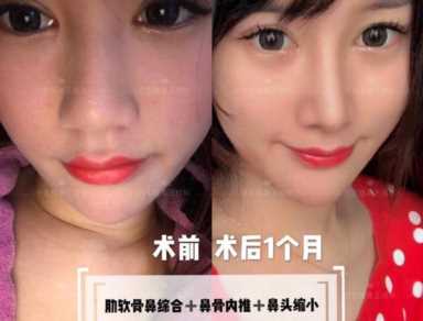 科学变美｜怎么提高正脸颜值，鼻骨内推必须了解