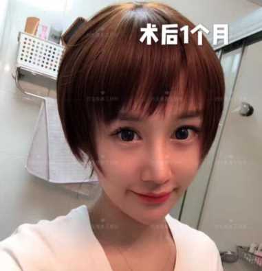 科学变美｜怎么提高正脸颜值，鼻骨内推必须了解