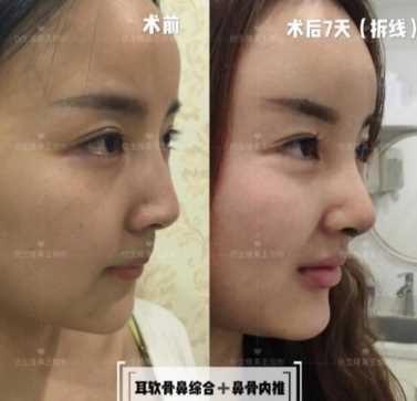 科学变美｜怎么提高正脸颜值，鼻骨内推必须了解