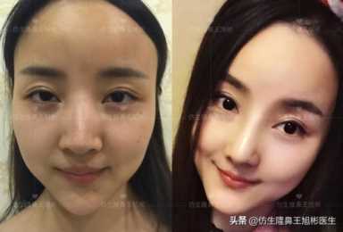 科学变美｜怎么提高正脸颜值，鼻骨内推必须了解
