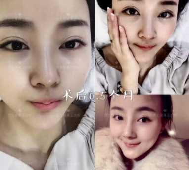 科学变美｜怎么提高正脸颜值，鼻骨内推必须了解