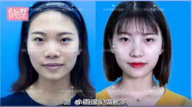 科学变美｜怎么提高正脸颜值，鼻骨内推必须了解