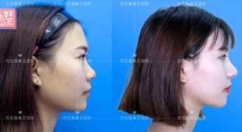 科学变美｜怎么提高正脸颜值，鼻骨内推必须了解